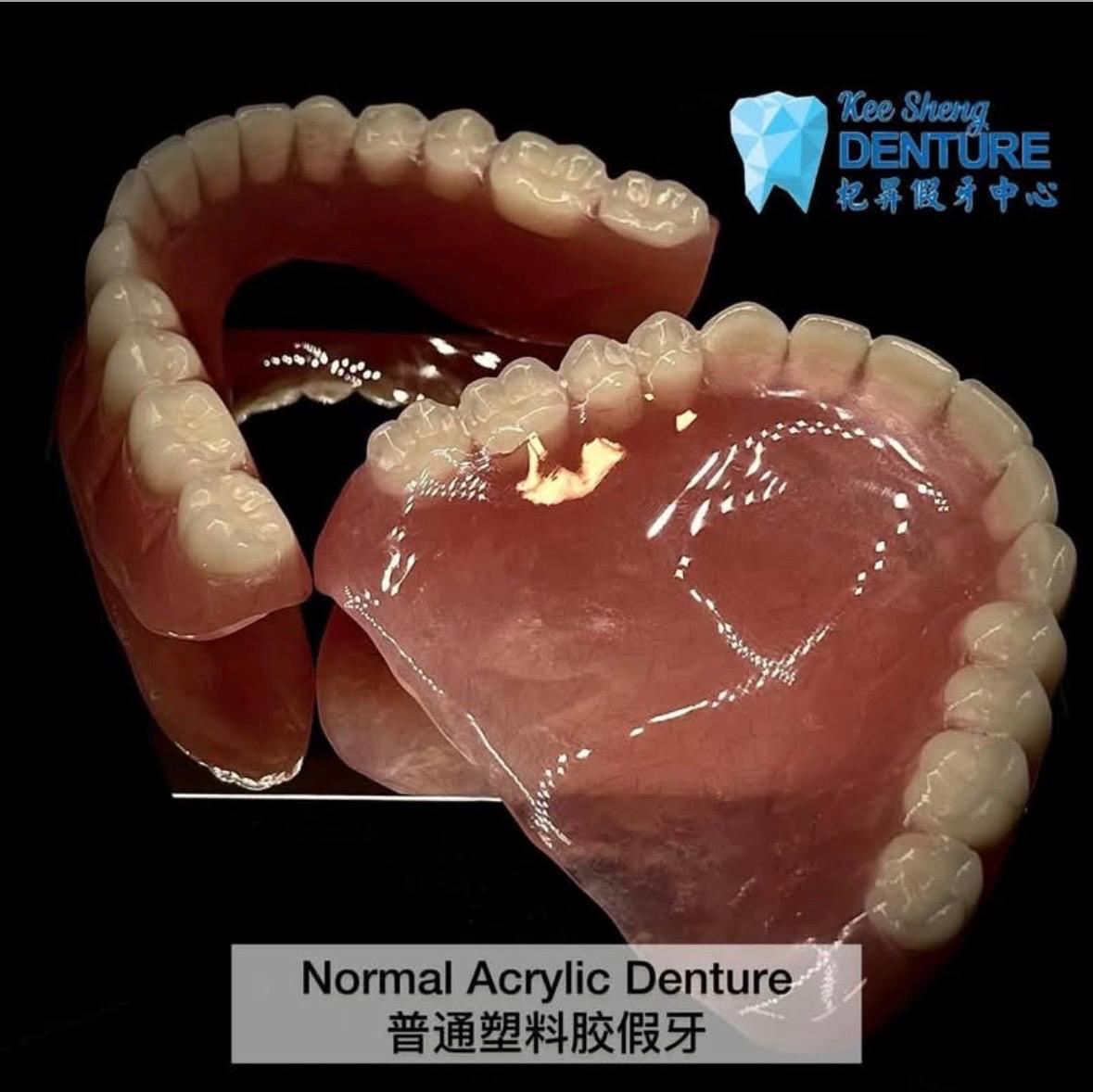 Normal Acrylic Denture